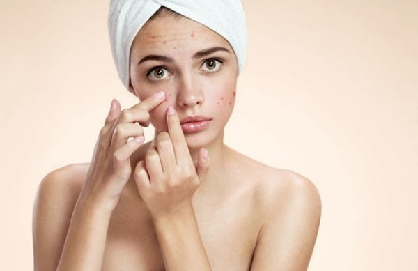 5 Pasos para cuidar tu piel grasa de forma natural.